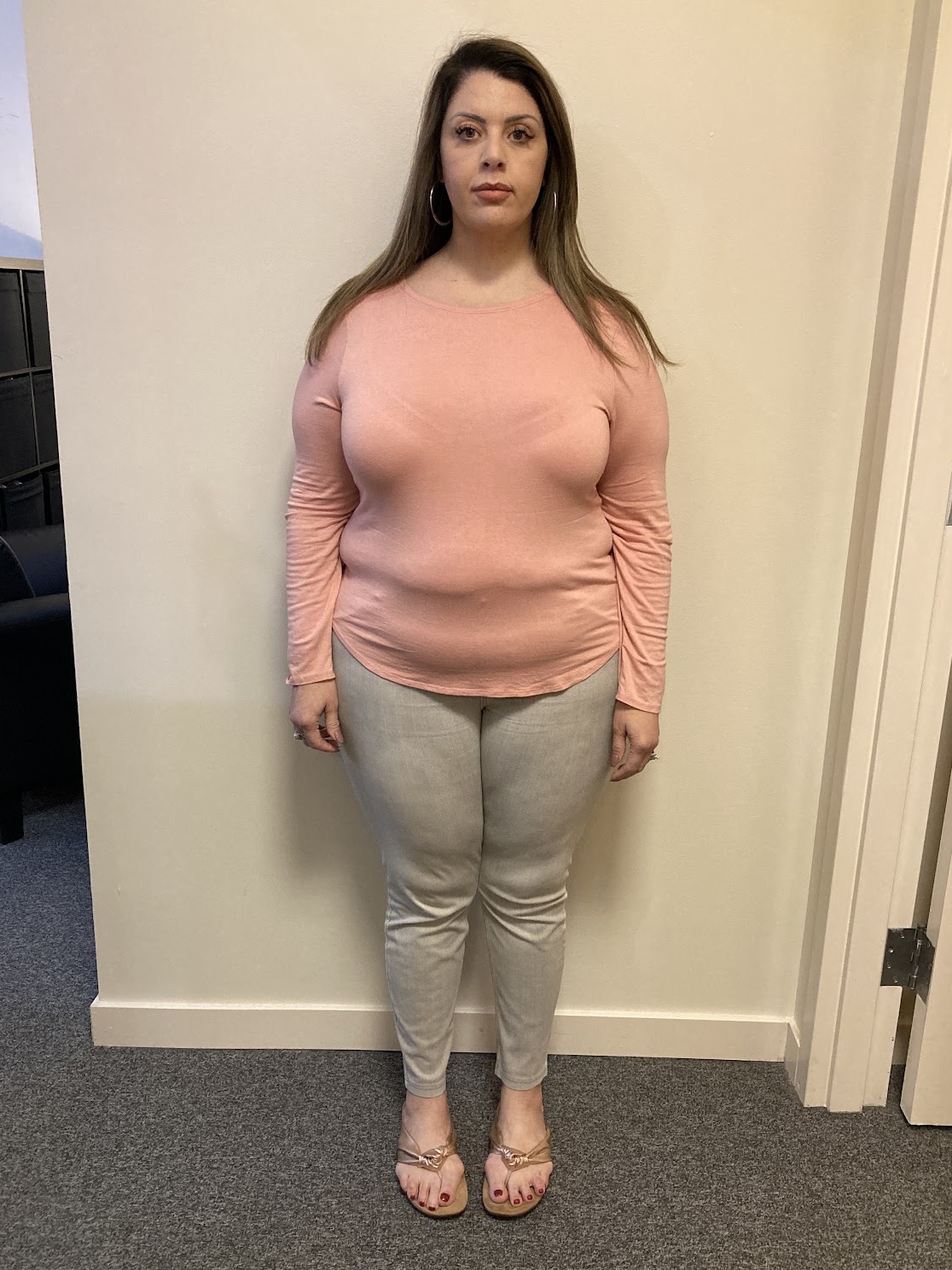 Iris before PHD Weight Loss